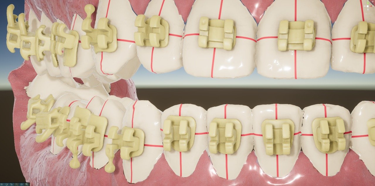 Actual BraceFlow software view showing brackets positioned on a three-dimensional dental arch
